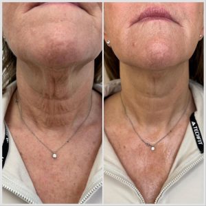 Botox Anti-wrinkle treatments Definity Aesthetics Clinic Tarporley cheshire