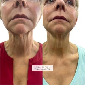 Botox Anti-wrinkle treatments Definity Aesthetics Clinic Tarporley cheshire