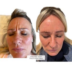 Botox Cheshire Anti-wrinkle treatments Definity Aesthetics Clinic Tarporley cheshire