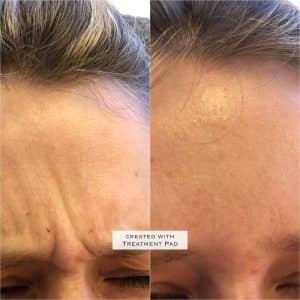 Botox Anti-wrinkle treatments Definity Aesthetics Clinic Tarporley cheshire