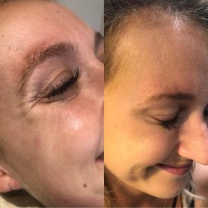 Botox Anti-wrinkle treatments Definity Aesthetics Clinic Tarporley cheshire