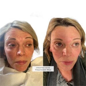 Botox Injections Tarporley Cheshire